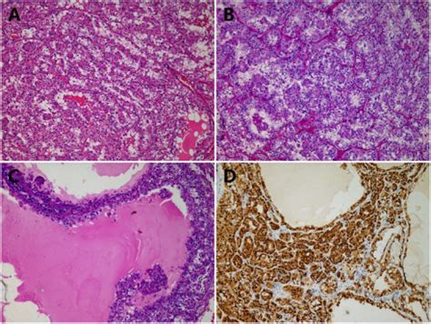 Exploration Of Clinicopathological Features Of Rearranged Renal Cell