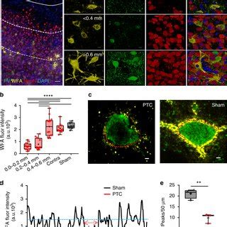 Disintegration Of Pnns In The Peritumoral Cortex A Confocal Images Of