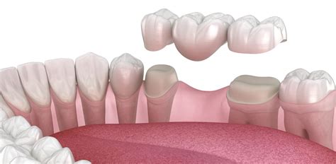 Can Ai Tools Aid Dental Prosthodontics Conexiant