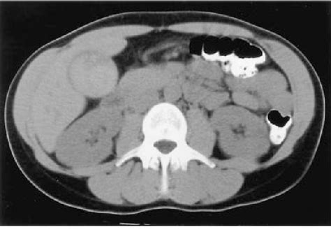 Figure 1 From Nephrology Dialysis Transplantation Haemobilia Mimicking