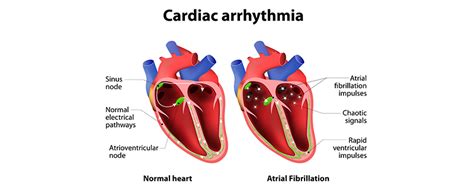 Understanding Arrhythmia Causes And Treatments Ask The Nurse Expert