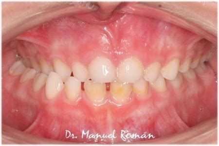 Mordida Cruzada Posterior Invisible Invisalign Dr Manuel Roman