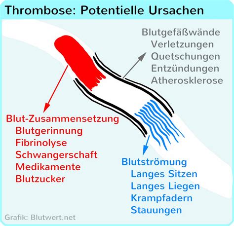 Thrombose Risiko Durch Blutgerinnsel Bildung