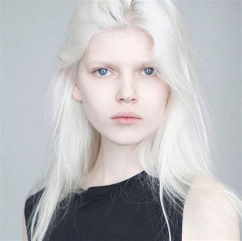 How Albinos From Various Races Look Like 22 Pics