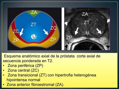 Prostata Hiperplasia Carcinoma Metodos Diagnosticos PPT Descarga