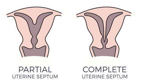 Laparoscopic Uterine Septum Resection Best Gynecologica