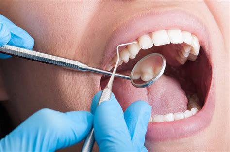 What Is The Lifespan Of A Root Canal Therapy And How Permanent Is It