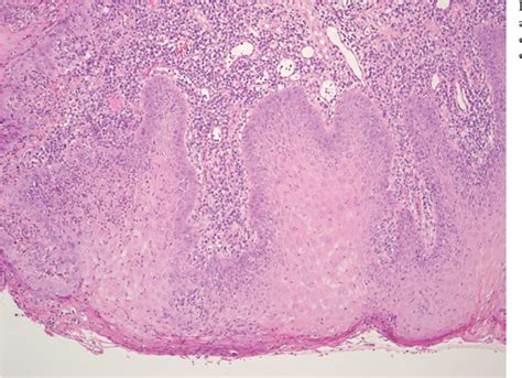 Figure 1 From Focal Epithelial Hyperplasia Hecks Disease Case