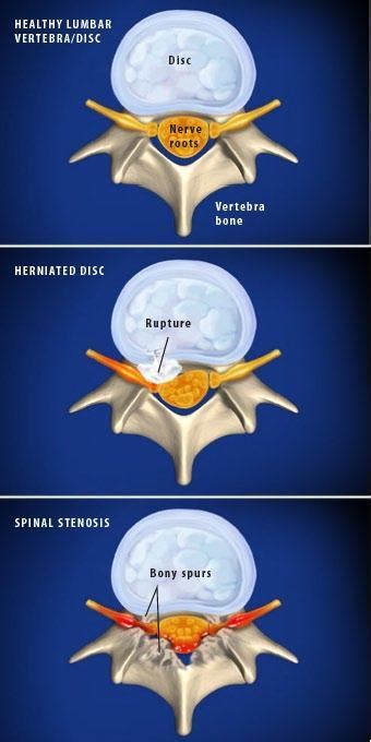 Lumbar Radiculopathy Sciatica Sarasota Fl Schofield Hand And