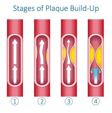 How Long Can You Live With Blocked Carotid Arteries Garret Bonner