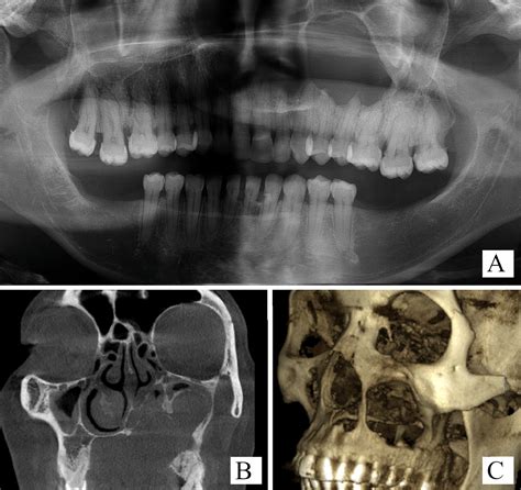 Clinical And Radiologic Spectrum Of Glandular Odontogenic Cysts A