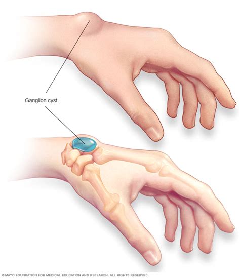 What Causes Ganglions To Form - Margaret Greene Kapsels