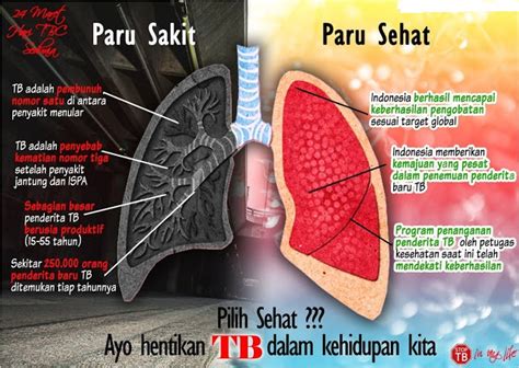 Harus Anda Ketahui Tanda Dan Gejala Tbc Agar Anda Bisa Terhindar