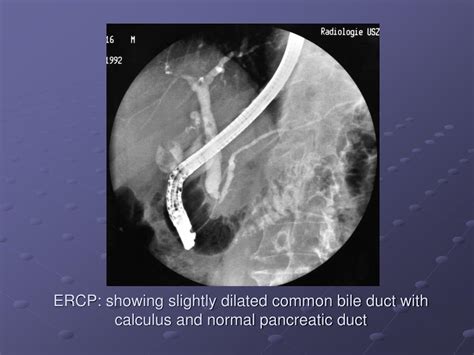 Ppt Biliary Imaging Powerpoint Presentation Free Download Id6761361