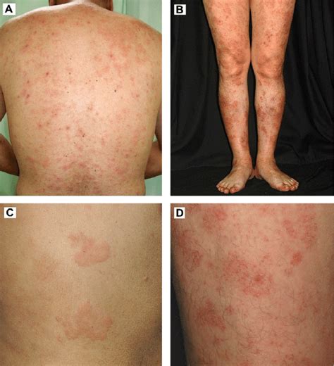 A B Generalized Wheal Like Papules And Plaques With Many Eczematous