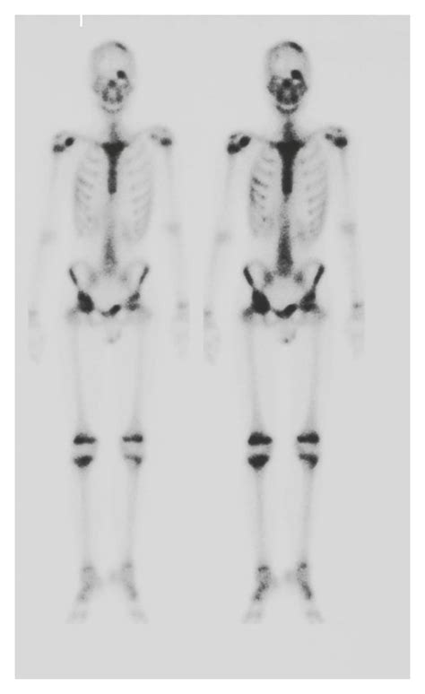 Bone Scintigraphy Showing Multiple Lesions In The Left Frontal Bone