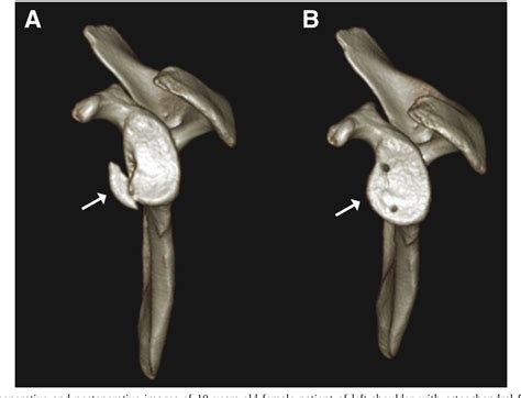 Figure From Arthroscopic Stabilization Of Osteochondral Fracture Of