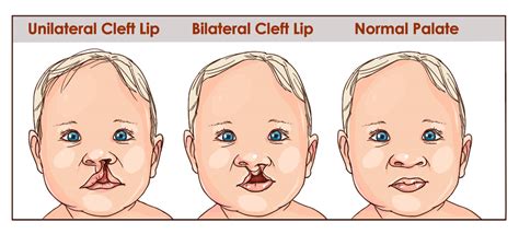 Cleft Lip Boy Dell Childrens Craniofacial Team Of Texas