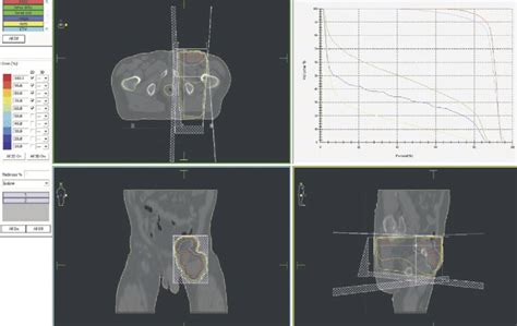 Radiation Therapy Lymph Nodes Groin All About Radiation