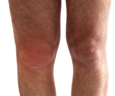 Swollen Knee Treatment Atelier Yuwa Ciao Jp