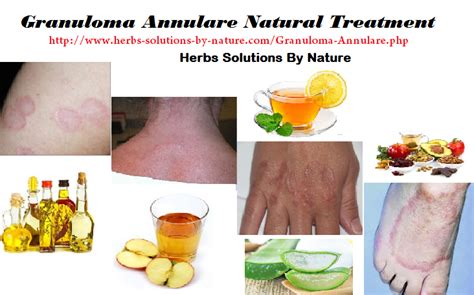 Granuloma Annulare Natural Treatment Herbs Solutions By Nature