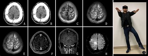 Cerebral Syphilitic Gumma Masquerading As Cerebral Metastatic Tumors