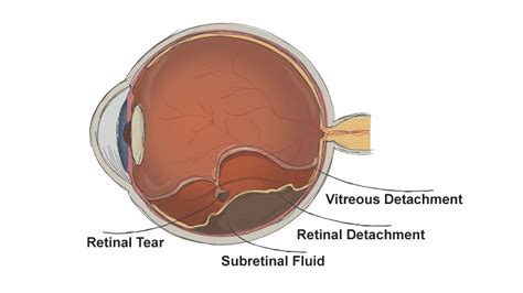 Posterior Vitreous Detachment Metrolina Eye Associates