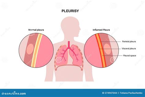 Pleurisy: Causes, Symptoms, Diagnosis, Treatment Prevention, 60% OFF