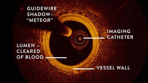 Heart Treatments Sozocardiology Dr Ooi Yau Wei Interventional