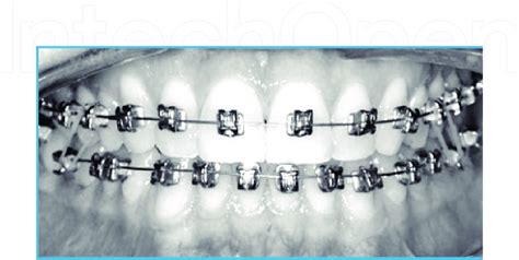 Gingival Bracket Placement For Smile Arc Protection By Dr Thomas Pitts