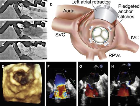 Hybrid Open Minimally Invasive Transcatheter Mitral Valve Replacement