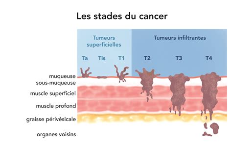 Le Stade Du Cancer Le Diagnostic Institut National Du Cancer