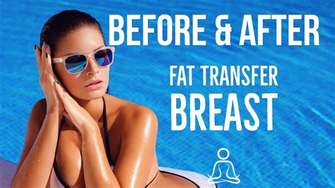 Fat Transfer Breast Augmentation Results With Beautifill YouTube