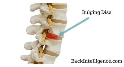 Bulging Disc Exercises In Lower Back - Do These At Home