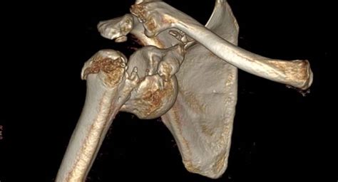 Proximal Humerus Fracture Fixation Surgical Technique Published In Surgicoll