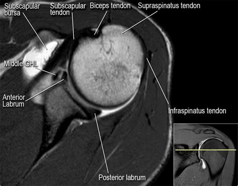 The Radiology Assistant Shoulder Mr Anatomy