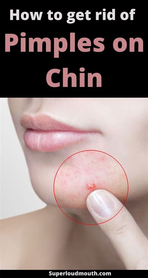 Pimples On Chin Meaning How To Get Rid Of Break Out On Chin Pimples On Chin How To Get Rid