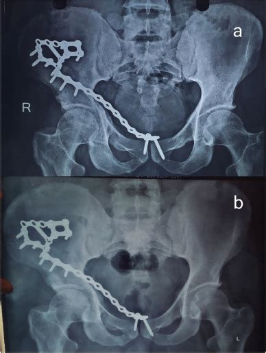 Use Of Calcaneal Plates In The Treatment Of Posterior Pelvic Ring Injuries And Displaced Iliac