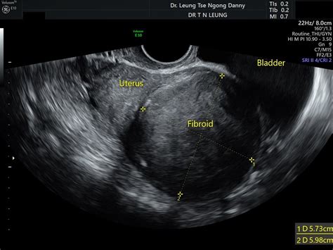 Uterus Fibroid Ultrasound