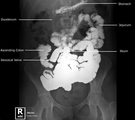 Abdominal Radiographic Anatomy Wikiradiography