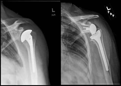 Reverse Shoulder Replacement - The Shoulder and Elbow Center