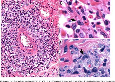 Figure From Alk Negative Anaplastic Large Cell Lymphoma Current