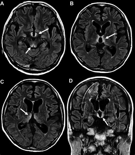 Wernicke Encephalopathy A Axial Fluid Attenuated Inversion Recovery