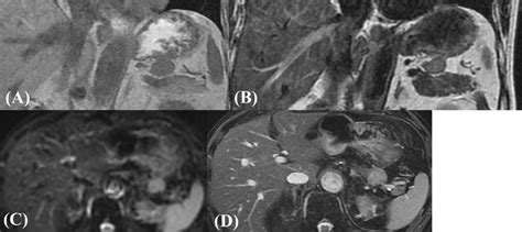 MRI Findings A T1WI B T2WI C DWI D FIESTA MRI Revealed A