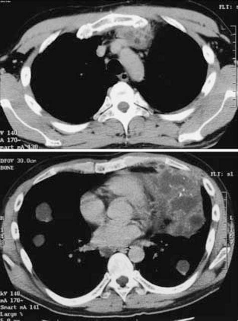 Figure 5 From A Case Of Primary Mixed Type Germ Cell Tumor Of The