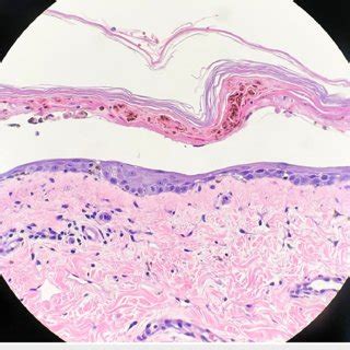 Skin Biopsy With Hematoxylin Eosin Stain Showing Fullthickness