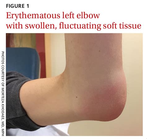 Painful, swollen elbow | MDedge Family Medicine