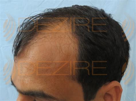 hair transplant doctor near me – Hair Transplant Pune