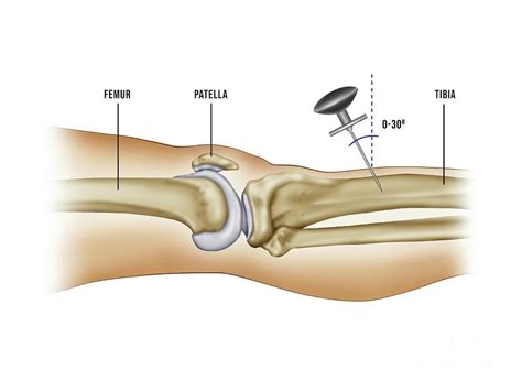 Intraosseous Infusion Photograph By Maurizio De Angelis Science Photo