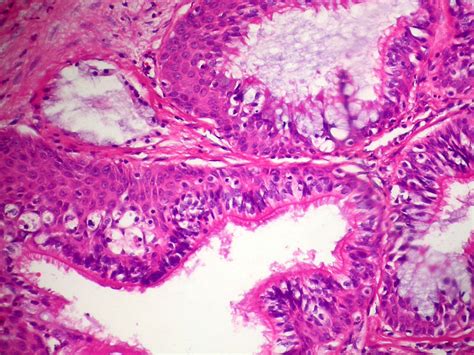 Pathology Outlines Mucoepidermoid Carcinoma